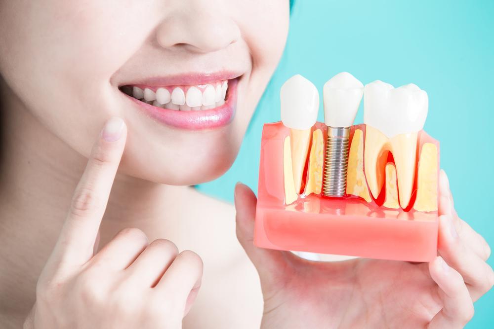 Restored smile with dental implants in Edinburg, McAllen, Pharr TX