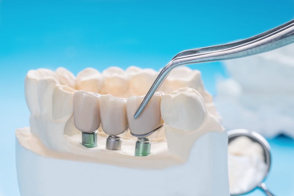 Crowns, veneers, and bridges treatment at Ethos Modern Dental in Edinburg, McAllen, Pharr TX