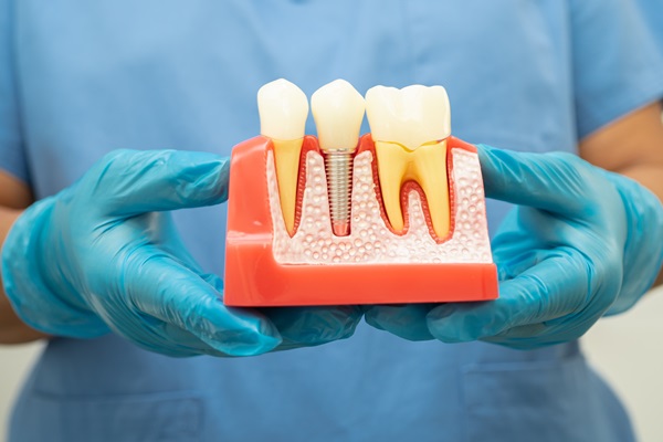 Root canal treatment in Edinburg, McAllen, Pharr TX -  Ethos Modern Dental