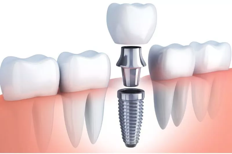 Missing teeth? Ethos Modern Dental offers advanced, natural-looking dental implants in Edinburg, McAllen, and Pharr, TX. Restore your confidence and smile with personalized, comfortable, and long-lasting implant solutions. Book your consultation today!