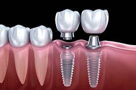 Missing teeth? Ethos Modern Dental offers advanced, natural-looking dental implants in Edinburg, McAllen, and Pharr, TX.