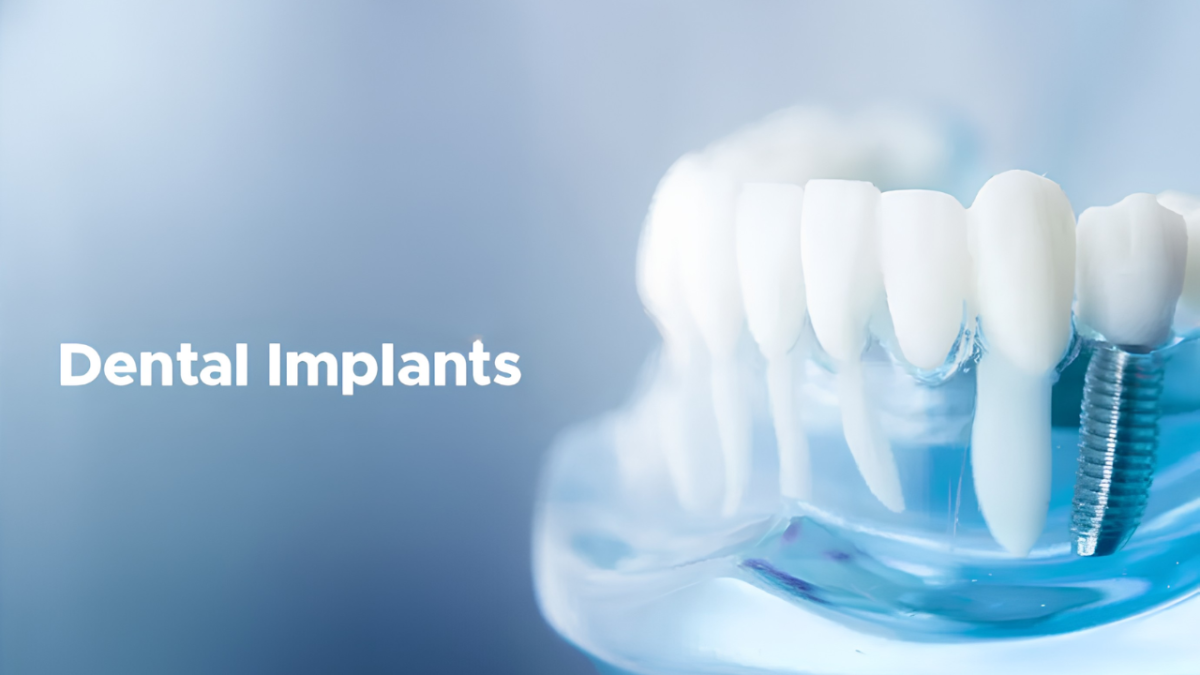 Dental implants